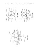 Fluid Drainage Catheter Having an External Flow Path diagram and image