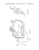 CIRCUMFERENTIAL ABLATION DEVICE ASSEMBLY diagram and image