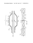 CIRCUMFERENTIAL ABLATION DEVICE ASSEMBLY diagram and image