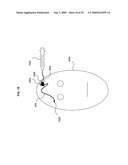 Shaped implantation device diagram and image