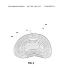 Nucleus implant and method of installing same diagram and image