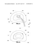 Nucleus implant and method of installing same diagram and image
