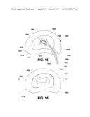 Nucleus implant and method of installing same diagram and image