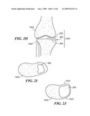 Articular Implants Providing Lower Adjacent Cartilage Wear diagram and image