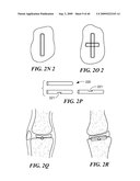 Articular Implants Providing Lower Adjacent Cartilage Wear diagram and image