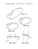 Articular Implants Providing Lower Adjacent Cartilage Wear diagram and image