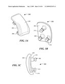 Articular Implants Providing Lower Adjacent Cartilage Wear diagram and image