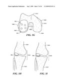 Articular Implants Providing Lower Adjacent Cartilage Wear diagram and image