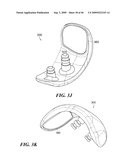 Articular Implants Providing Lower Adjacent Cartilage Wear diagram and image