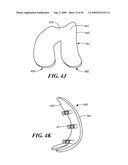 Articular Implants Providing Lower Adjacent Cartilage Wear diagram and image