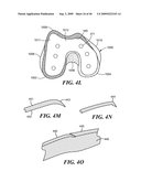 Articular Implants Providing Lower Adjacent Cartilage Wear diagram and image