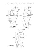 Articular Implants Providing Lower Adjacent Cartilage Wear diagram and image