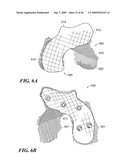 Articular Implants Providing Lower Adjacent Cartilage Wear diagram and image