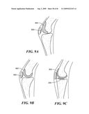 Articular Implants Providing Lower Adjacent Cartilage Wear diagram and image