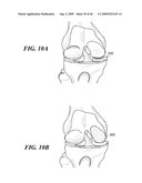 Articular Implants Providing Lower Adjacent Cartilage Wear diagram and image