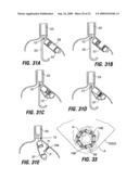 ENDOSCOPIC STAPLING DEVICES AND METHODS diagram and image