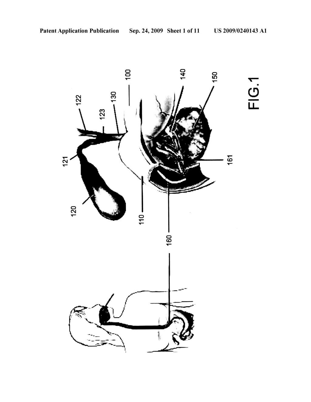 METHOD AND AN OPTICAL PROBE FOR IN VIVO IMAGING OF A MUCOSA IN A BILIARY OR PANCREATIC SYSTEM AND A METHOD FOR SELECTIVELY OPERATING A TISSUE SAMPLING OF A MUCOSA IN A BILIARY OR PANCREATIC SYSTEM - diagram, schematic, and image 02