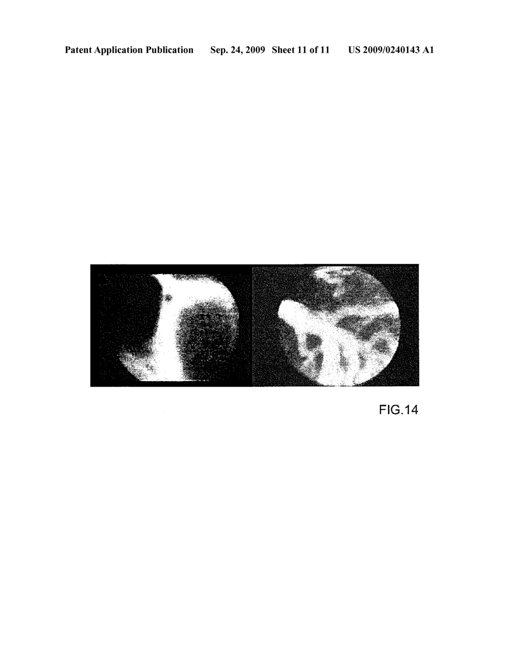 METHOD AND AN OPTICAL PROBE FOR IN VIVO IMAGING OF A MUCOSA IN A BILIARY OR PANCREATIC SYSTEM AND A METHOD FOR SELECTIVELY OPERATING A TISSUE SAMPLING OF A MUCOSA IN A BILIARY OR PANCREATIC SYSTEM - diagram, schematic, and image 12