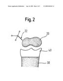 JOINT IMPLANT PLACEMENT diagram and image