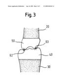 JOINT IMPLANT PLACEMENT diagram and image