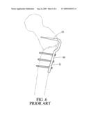 TARGETING APPARATUS CONNECTING TO LOCKING NAILS FOR THE CORRECTION AND FIXATION OF FEMUR DEFORMITY OF A CHILD diagram and image