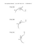 Intracoelomic suturing and ligating method diagram and image