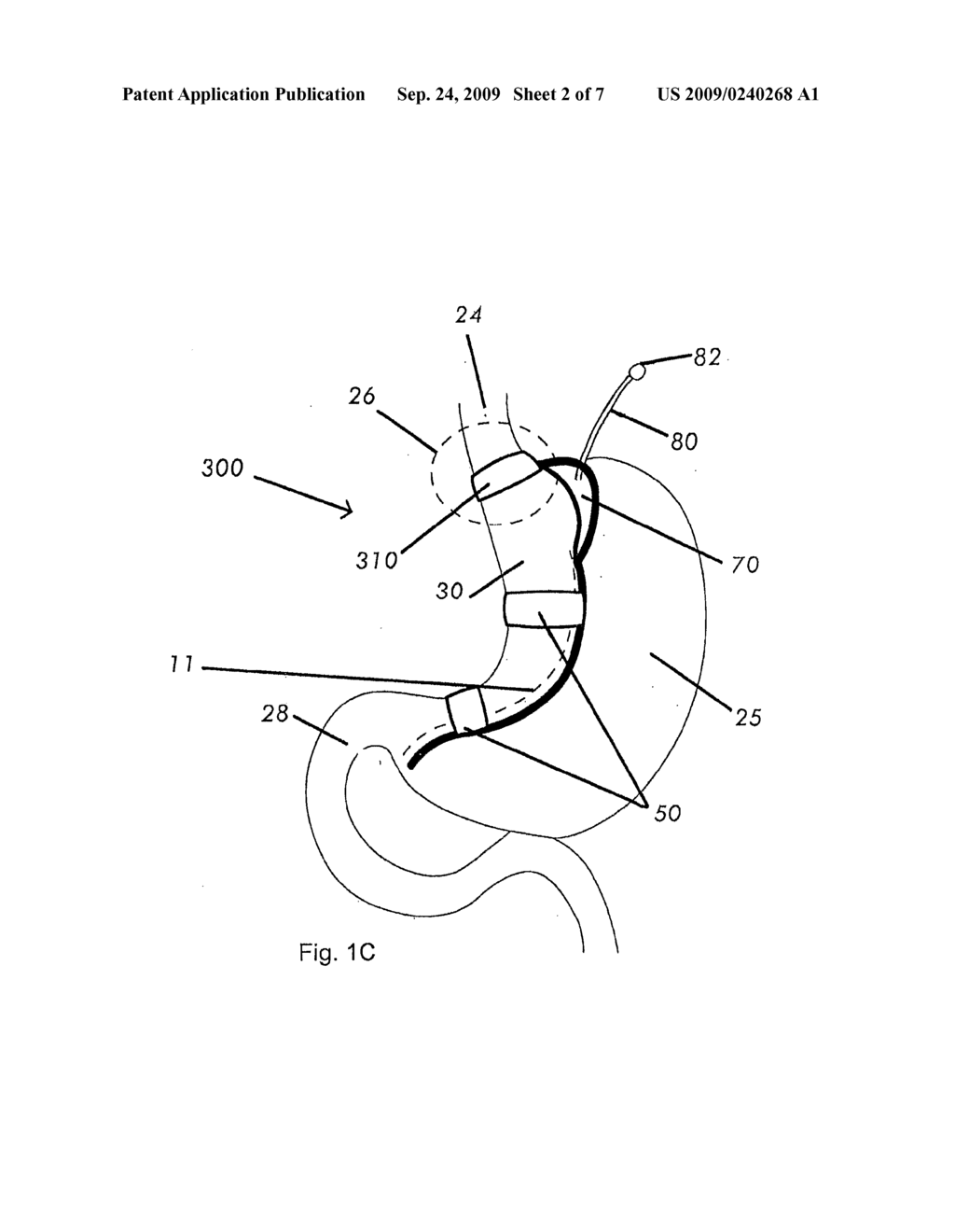 MAGNETIC DEVICES FOR ORGAN REMODELING - diagram, schematic, and image 03