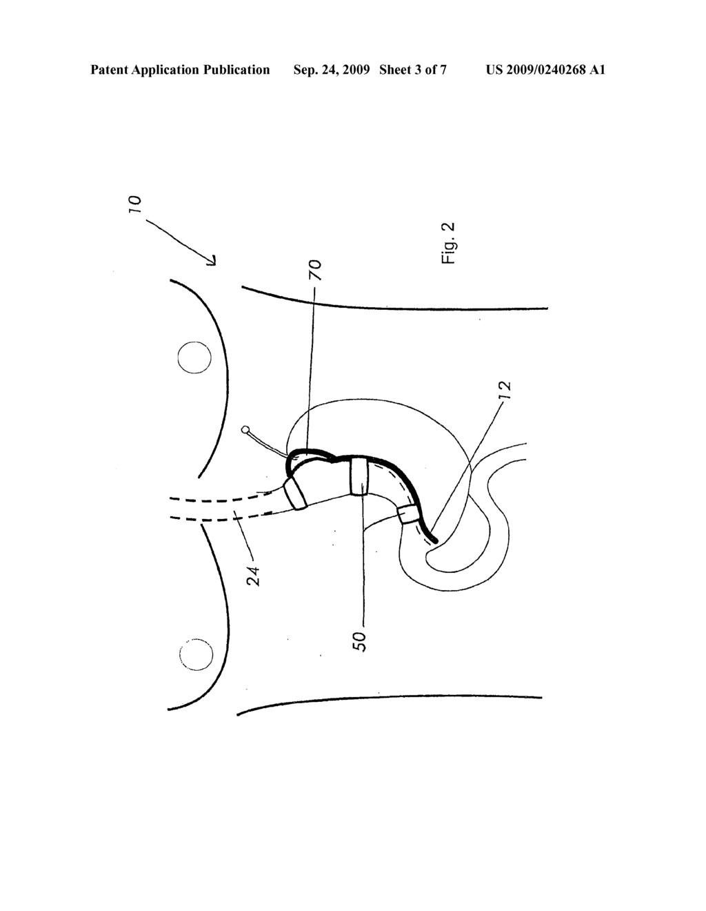 MAGNETIC DEVICES FOR ORGAN REMODELING - diagram, schematic, and image 04