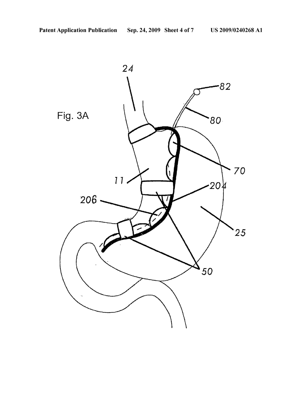 MAGNETIC DEVICES FOR ORGAN REMODELING - diagram, schematic, and image 05