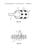 DEVICE AND METHOD FOR OPENING BLOOD VESSELS BY PRE-ANGIOPLASTY SERRATION AND DILATATION OF ATHEROSCLEROTIC PLAQUE diagram and image