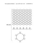 DEVICE AND METHOD FOR OPENING BLOOD VESSELS BY PRE-ANGIOPLASTY SERRATION AND DILATATION OF ATHEROSCLEROTIC PLAQUE diagram and image