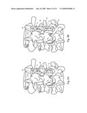 Interspinous implant, tools and methods of implanting diagram and image