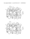 Interspinous implant, tools and methods of implanting diagram and image