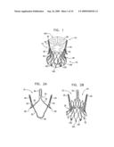 VALVE SUTURING AND IMPLANTATION PROCEDURES diagram and image