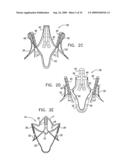 VALVE SUTURING AND IMPLANTATION PROCEDURES diagram and image