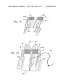 VALVE SUTURING AND IMPLANTATION PROCEDURES diagram and image