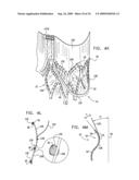 VALVE SUTURING AND IMPLANTATION PROCEDURES diagram and image