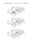 VALVE SUTURING AND IMPLANTATION PROCEDURES diagram and image