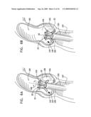 VALVE SUTURING AND IMPLANTATION PROCEDURES diagram and image