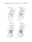 VALVE SUTURING AND IMPLANTATION PROCEDURES diagram and image