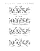 VALVE SUTURING AND IMPLANTATION PROCEDURES diagram and image