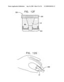 VALVE SUTURING AND IMPLANTATION PROCEDURES diagram and image