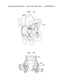 VALVE SUTURING AND IMPLANTATION PROCEDURES diagram and image