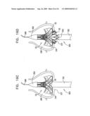 VALVE SUTURING AND IMPLANTATION PROCEDURES diagram and image