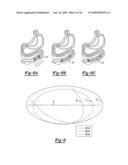 MECHANICAL EXTENSION IMPLANTS FOR SHORT BOWEL SYNDROME diagram and image