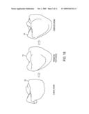 RECONSTRUCTION OF NON-VISIBLE PART OF TOOTH diagram and image