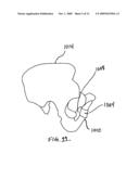 IMPLANTABLE SLING FOR THE TREATMENT OF INCONTINENCE AND METHOD OF USING THE SAME diagram and image