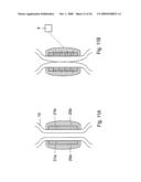 Method for the treatment of gallstones diagram and image