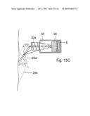 Method for the treatment of gallstones diagram and image