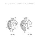 Method for the treatment of gallstones diagram and image